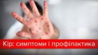 Спалах кору в Україні